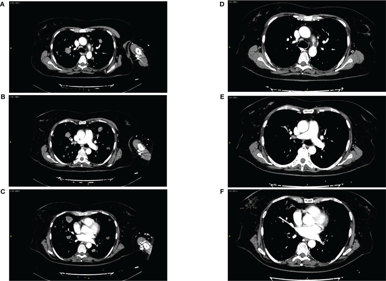 Frontiers | Pembrolizumab plus lenvatinib in advanced endometrial ...